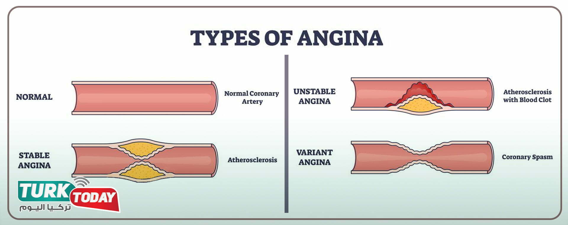 أنواع تصلب الشرايين