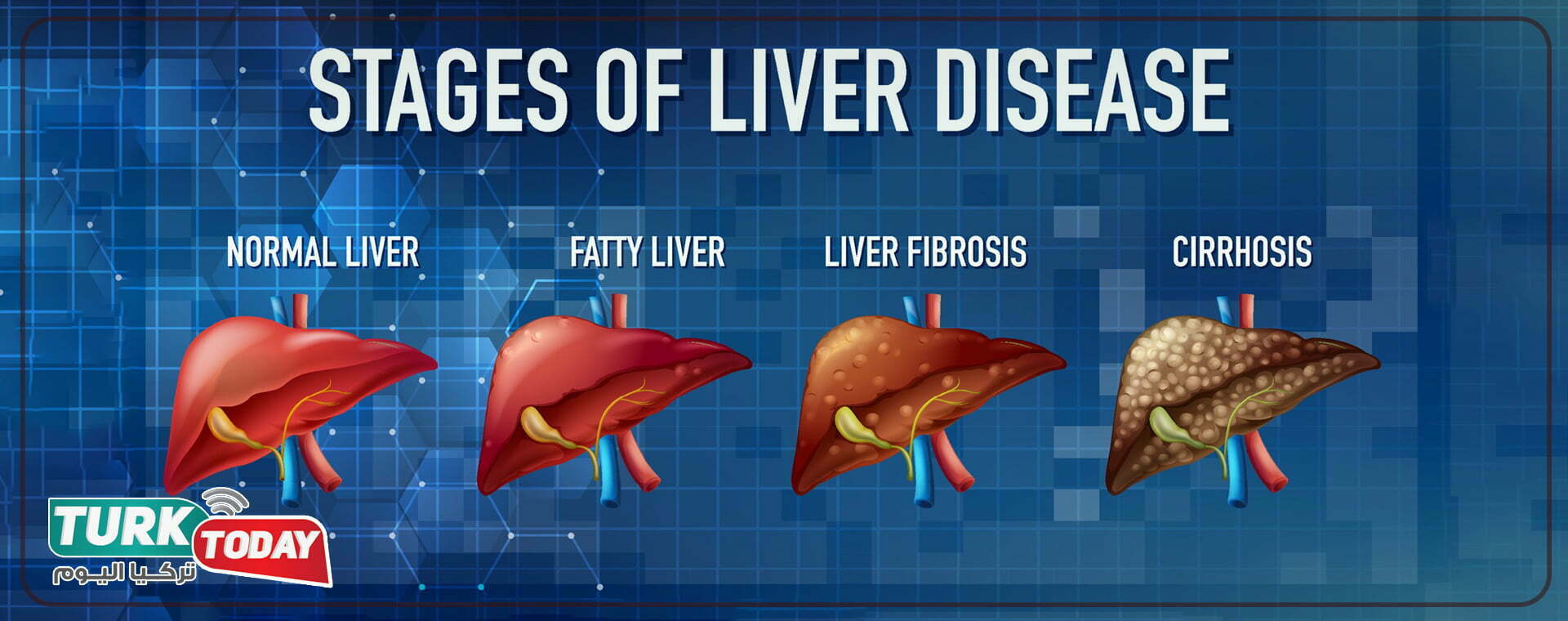 تشخيص تليف الكبد