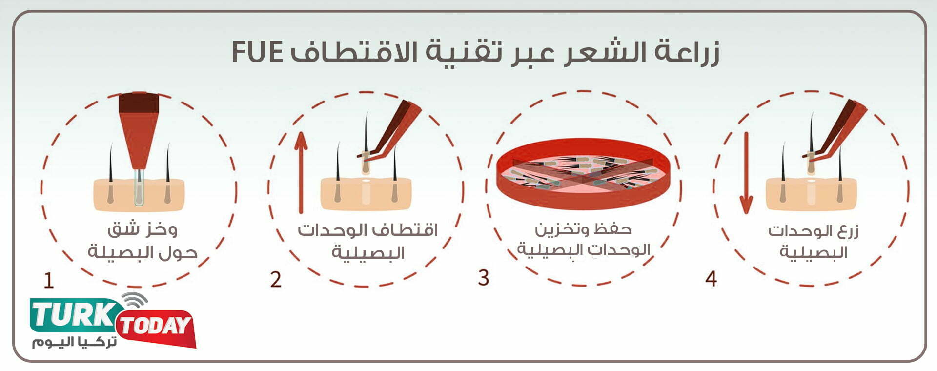 تقنية الاقتطاف FUE