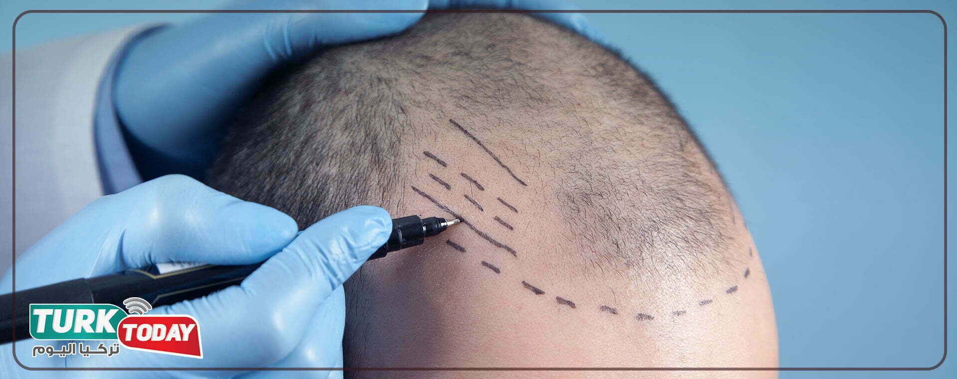 تقنية الاقتطاف الدقيق Nano-FUE