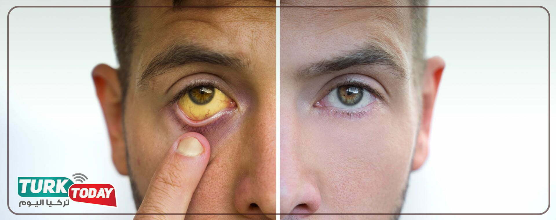 تليف الكبد - أسبابه وأهم العلامات