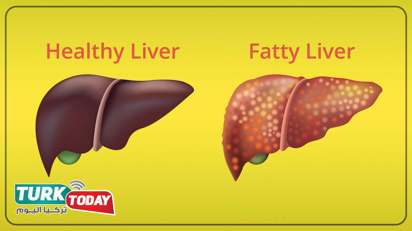 تليف الكبد المتقدم