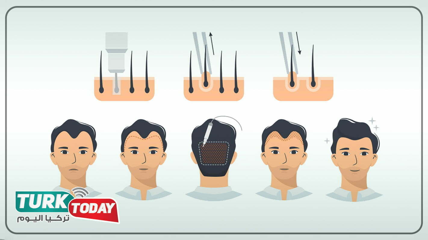زراعة الشعر عبر أقلام تشوي DHI