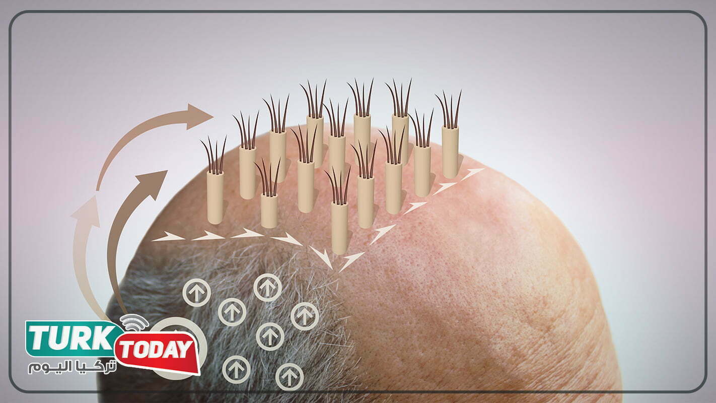 زراعة الشعر عبر تقنية الاقتطاف FUE