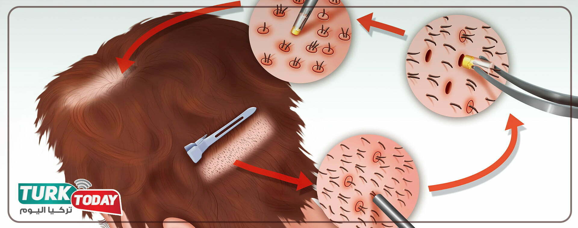 زراعة الشعر عبر تقنية البيركوتان