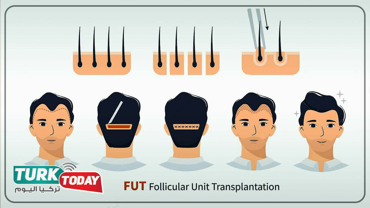زراعة الشعر عبر تقنية فوت FUT