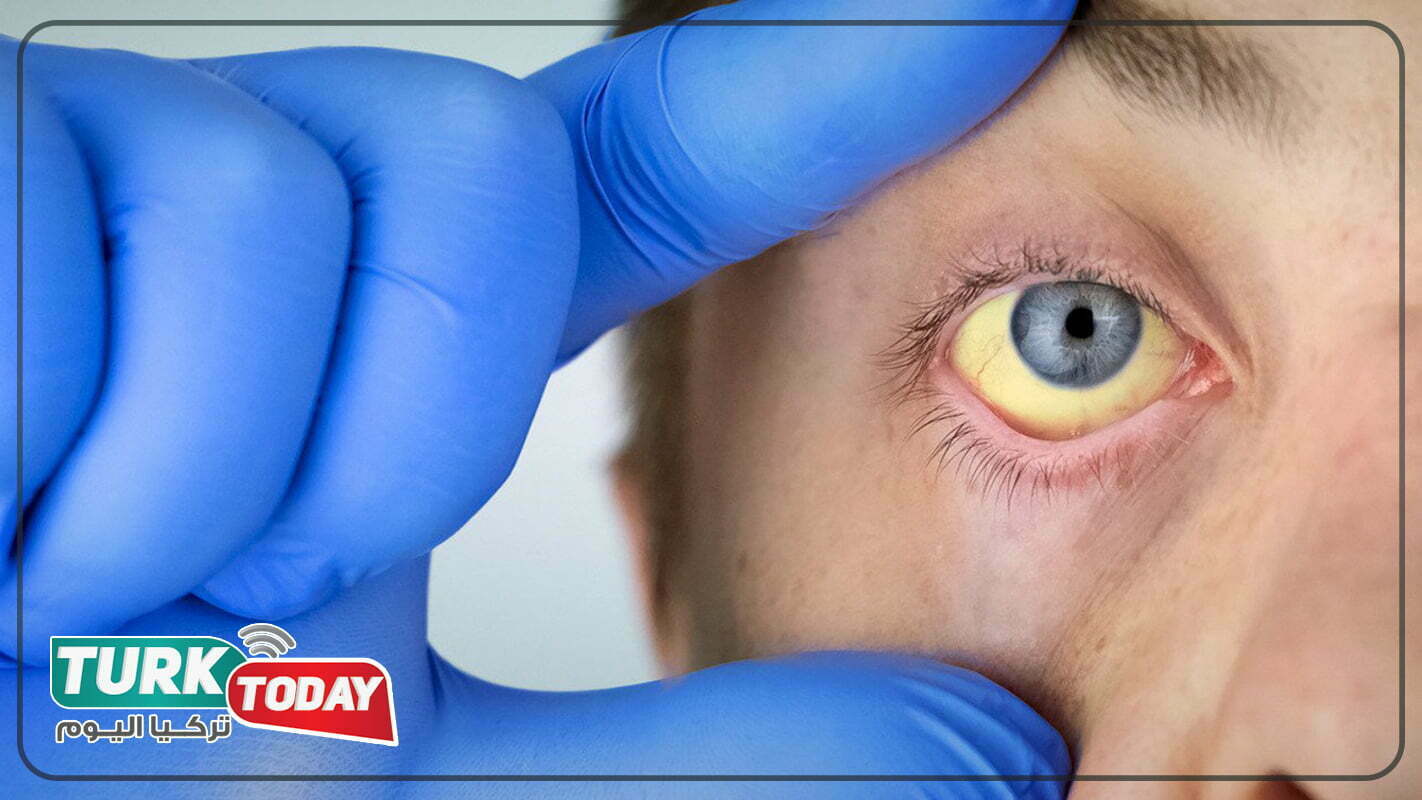 علامات تليف الكبد