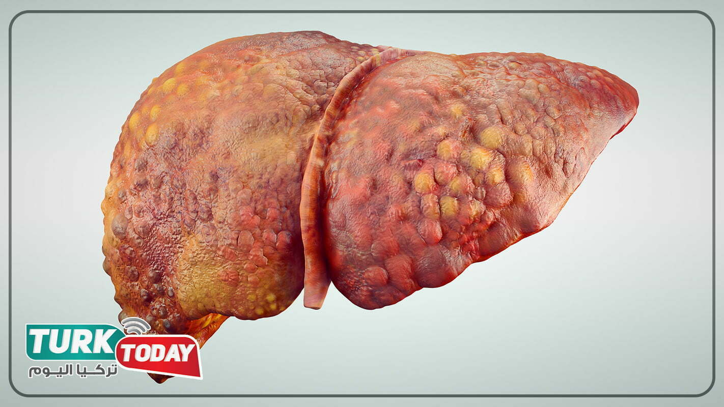 عواقب تليف الكبد