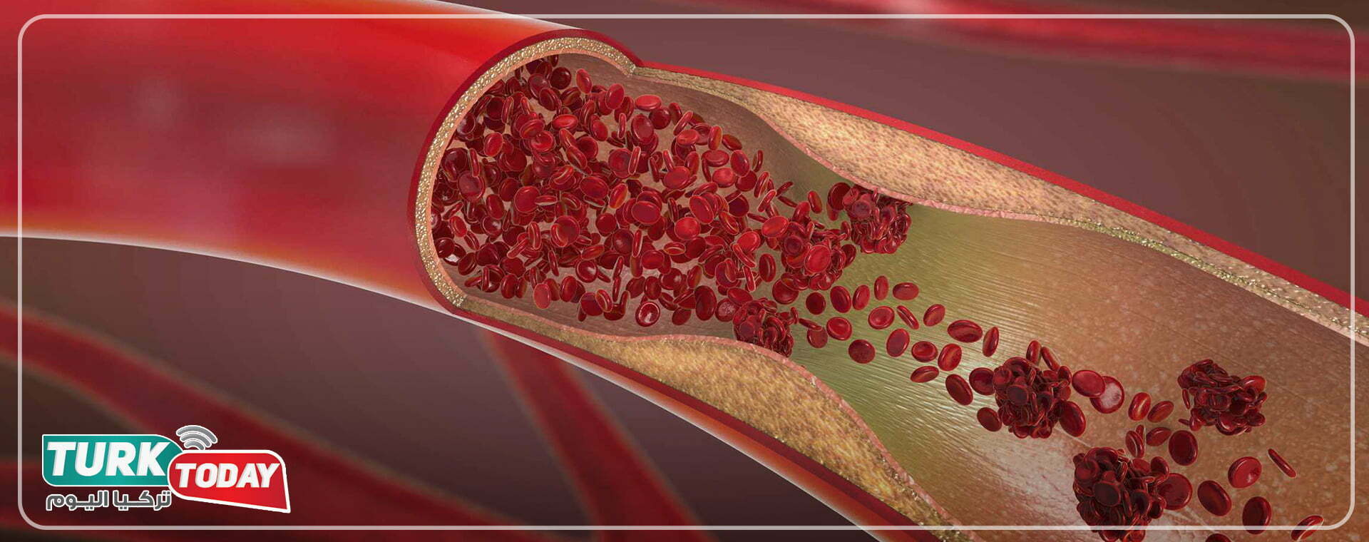 ما هو تصلب الشرايين؟