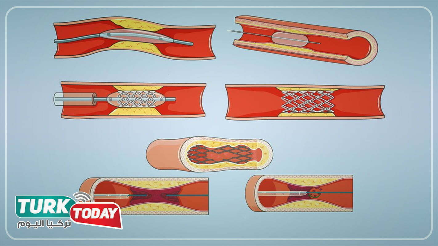 تصلب الشرايين 7 علامات تدل على انسداد الشرايين تركيا اليوم
