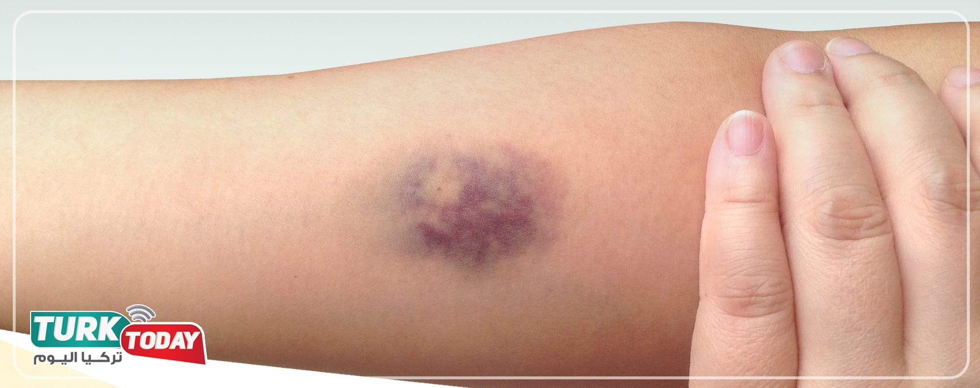 تشخيص الكدمات الزرقاء في الجسم