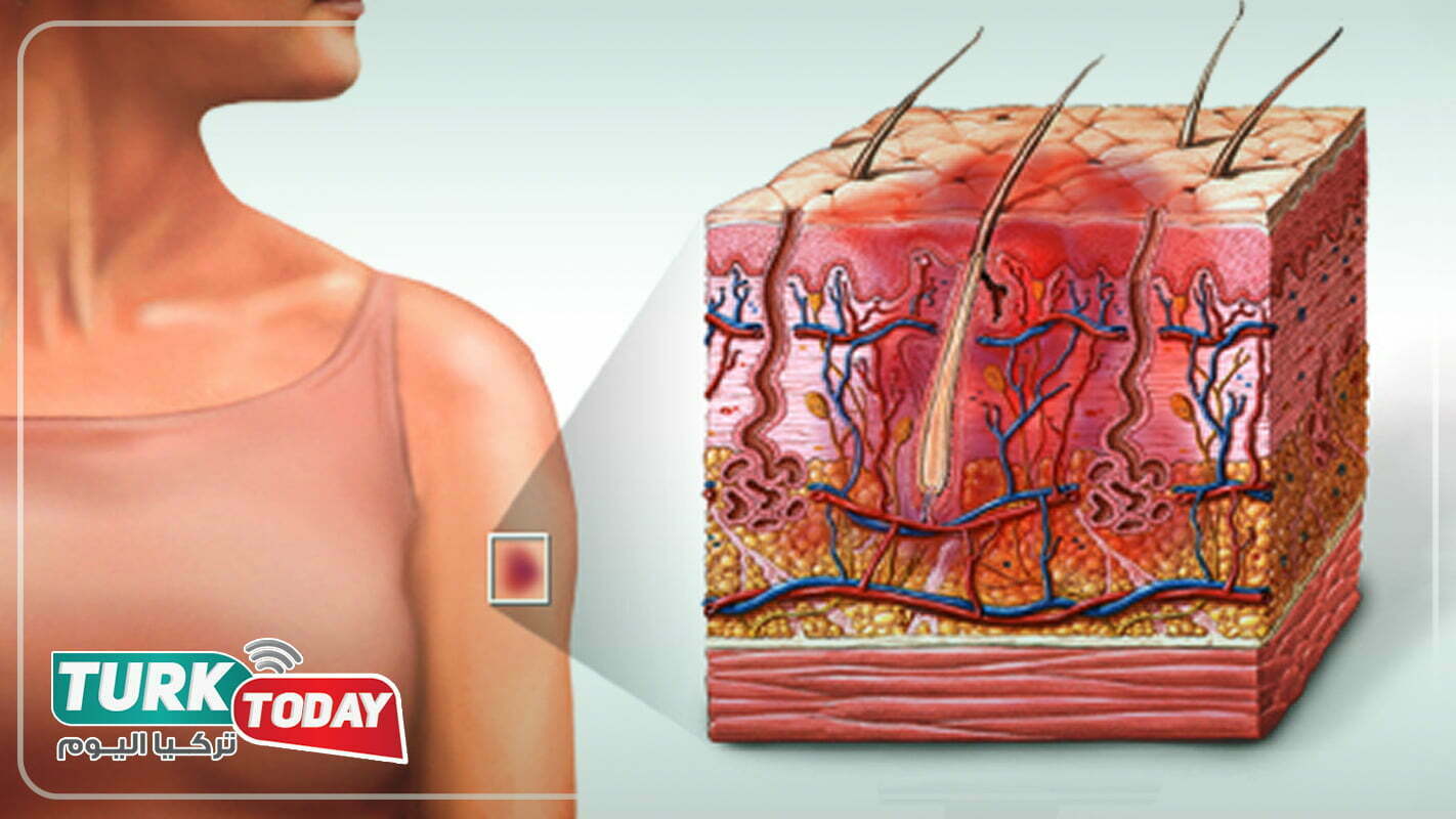 سبب تغير لون الكدمات