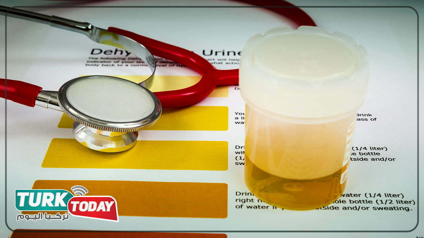 أسباب البول الغامق