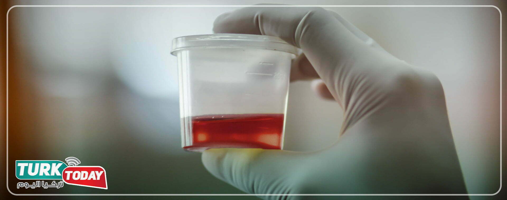 لون البول الاحمر